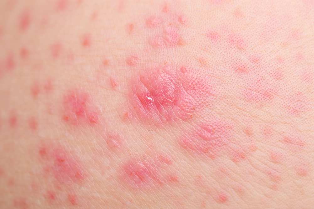 Pityriasis Rosé de Gibert : Symptômes, causes et traitement