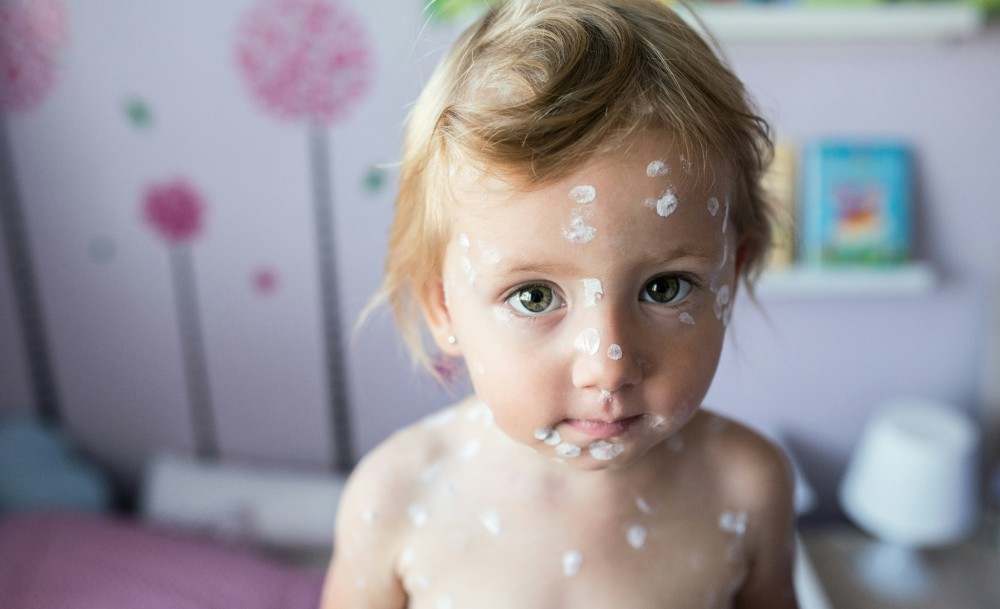 Enfant avec crème sur boutons pour apaiser démangeaisons varicelle