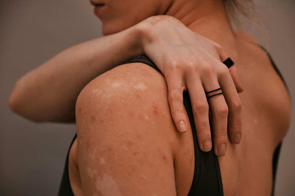Femme ayant pityriasis versicolor maladie de peau