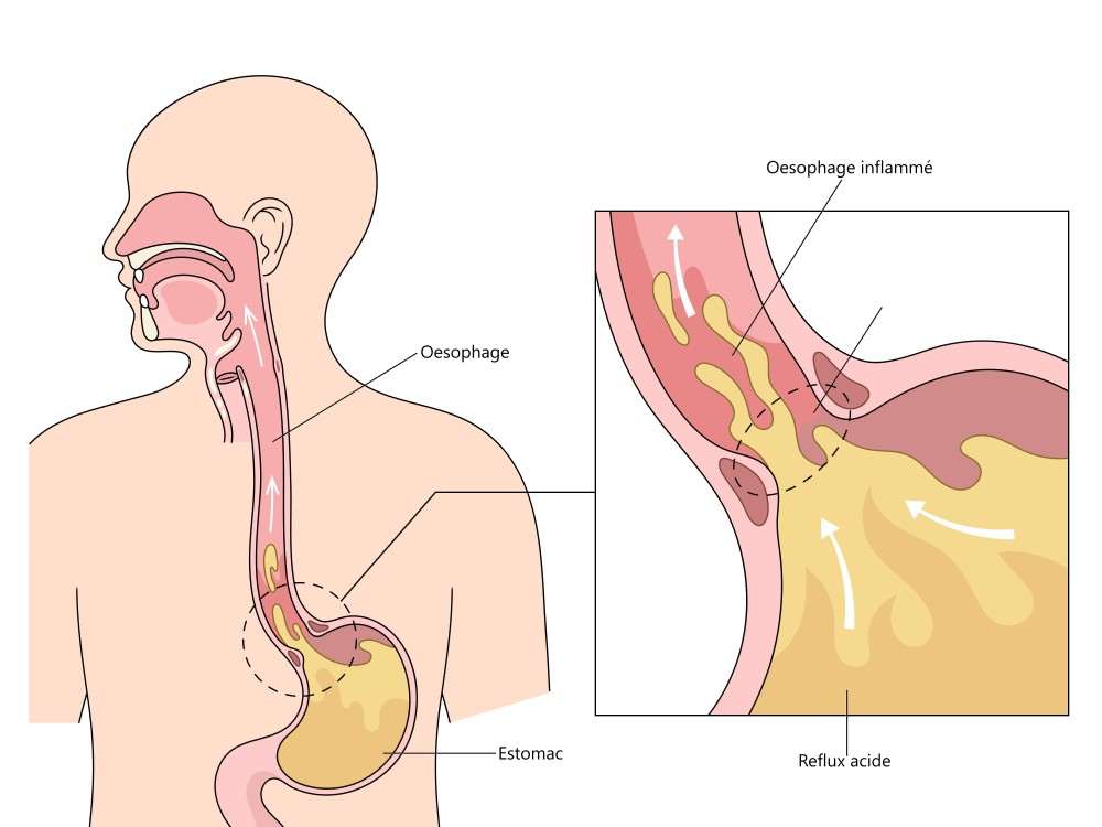 Que boire en cas de brlure d'estomac ? - cnerea.fr