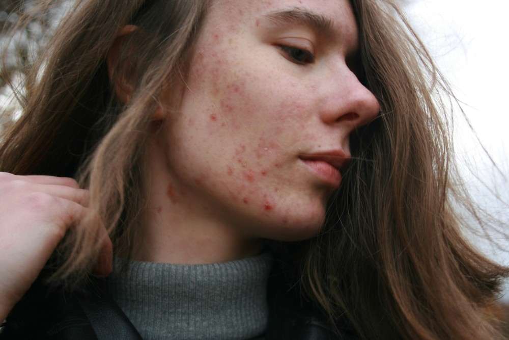 Bouton blanc visage : Grain de milium ou acné ?
