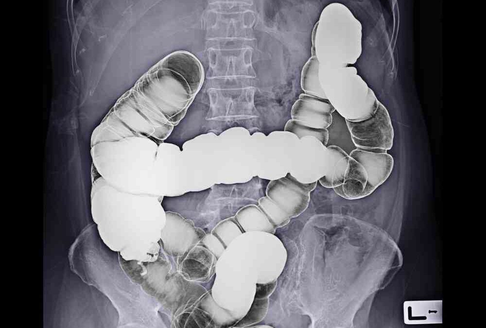 Coloscanner : Préparation, effets secondaires, durée, avis