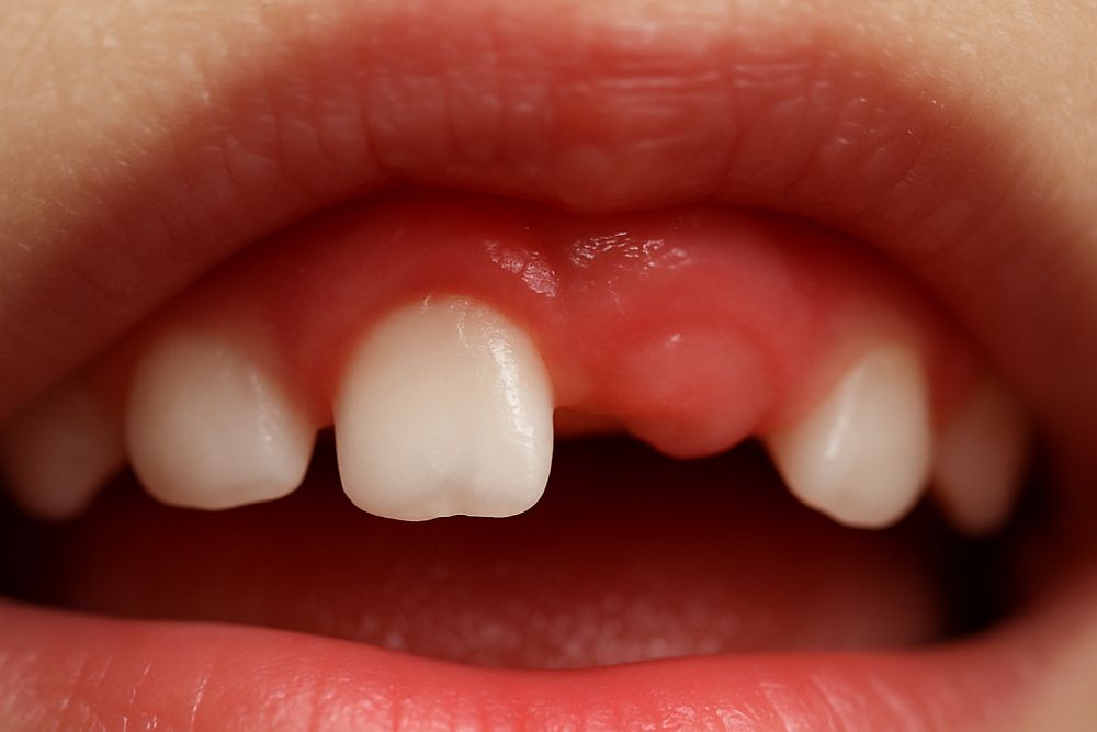 photo-dent-qui-perce- Photo dent qui perce