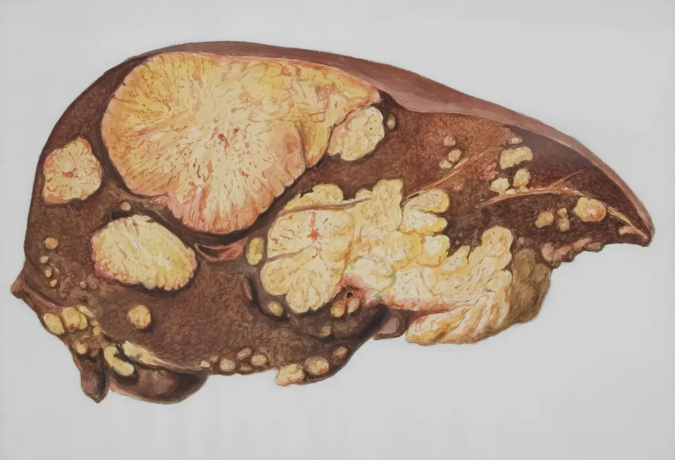 Illustration anatomique d'un foie gras avec dépôts de stéatose hépatique