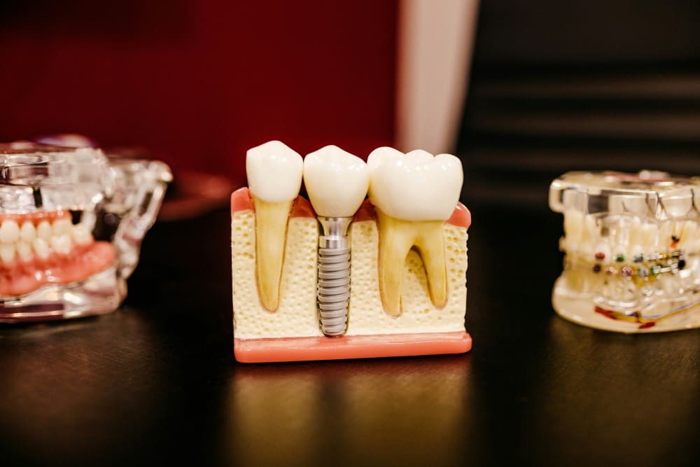 Implant dentaire en titane