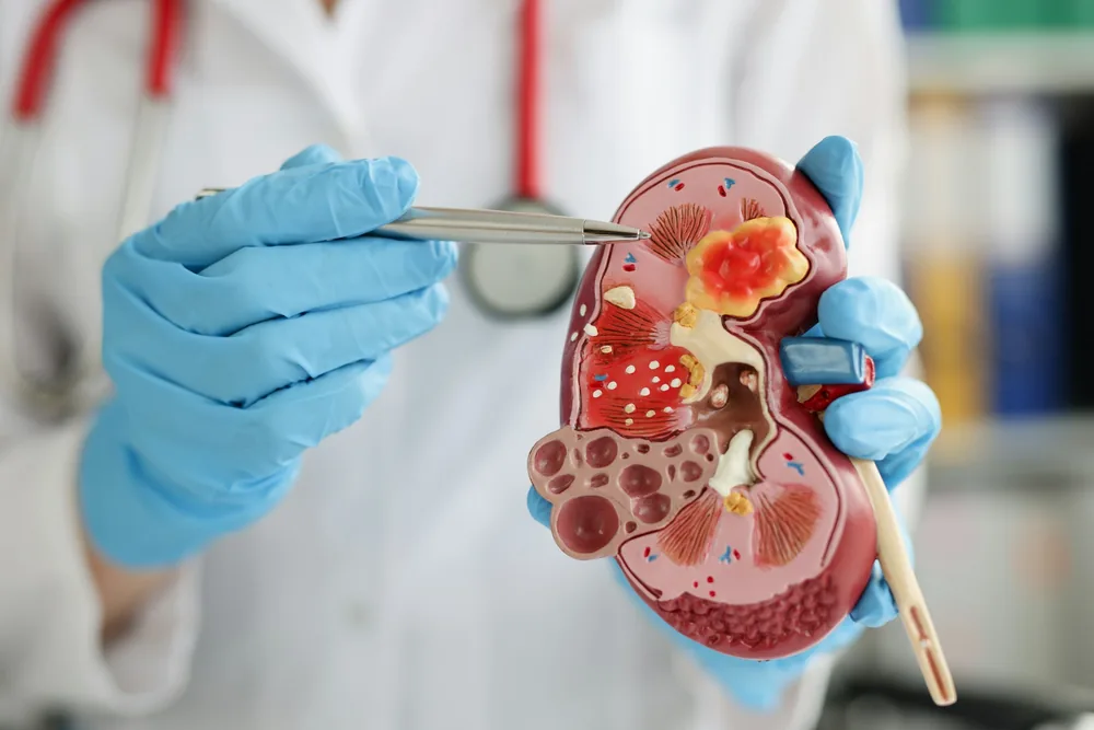 Médecin en blouse blanche montrant un modèle anatomique d'un rein affecté par une pyélonéphrite