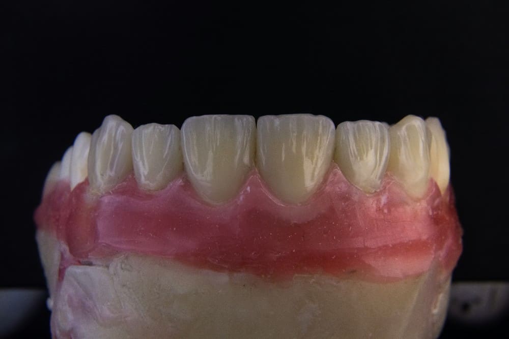 Photo d'un dentier réparé