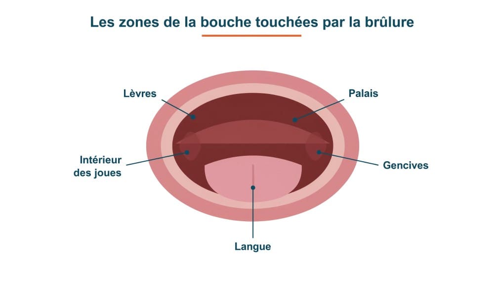 Syndrome de la bouche brûlante : Causes, symptômes et traitements