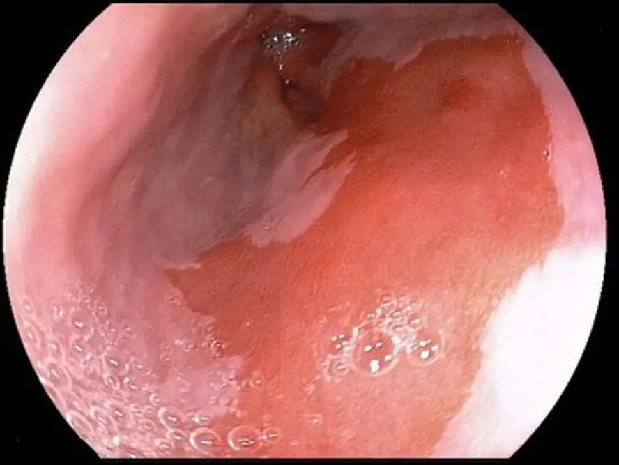 Vue endoscopique de la muqueuse de l'œsophage, avec des zones roses et rouge orangé.