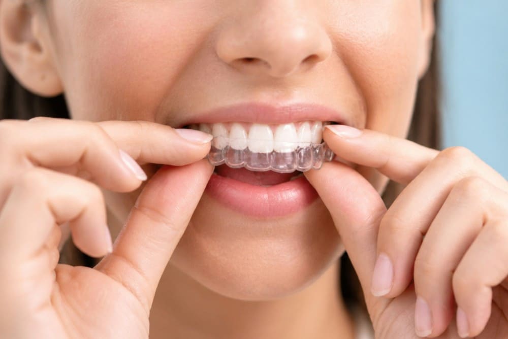 Aligneurs dentaires, gouttière pour femme