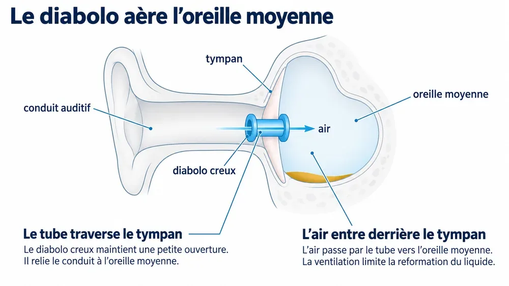 Le diabolo aère l’oreille moyenne : le tube maintient une ouverture à travers le tympan.