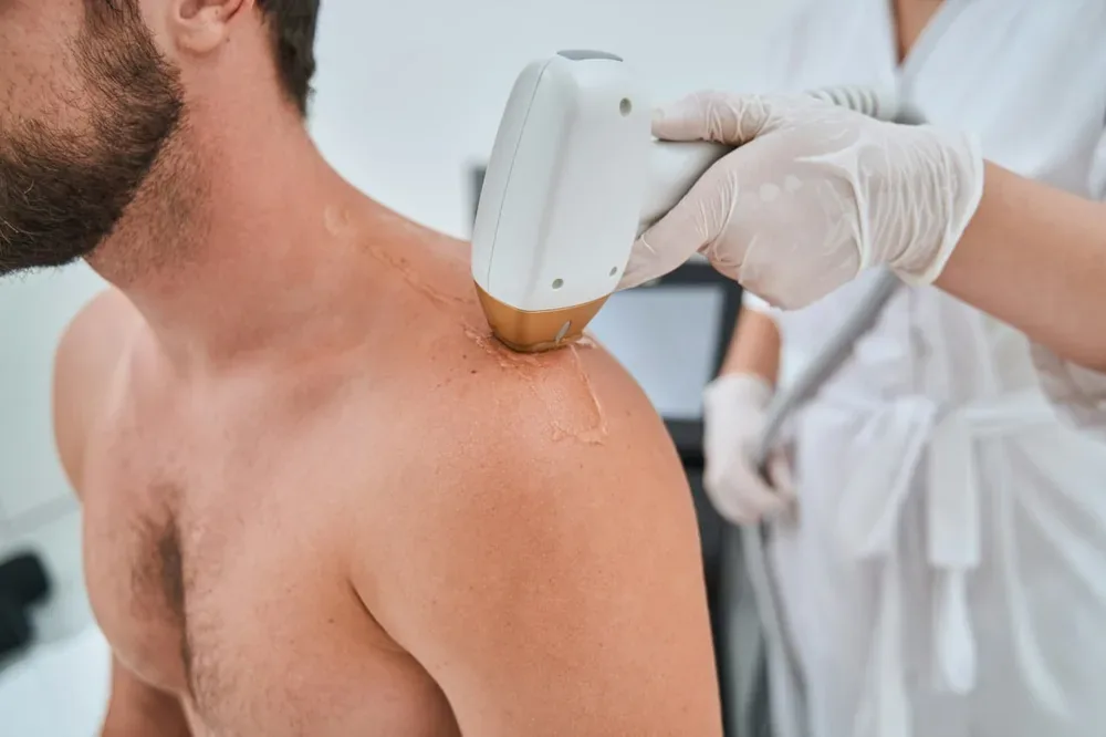 Épilation du dos chez l’homme : cire, rasoir, crème dépilatoire ou laser ?